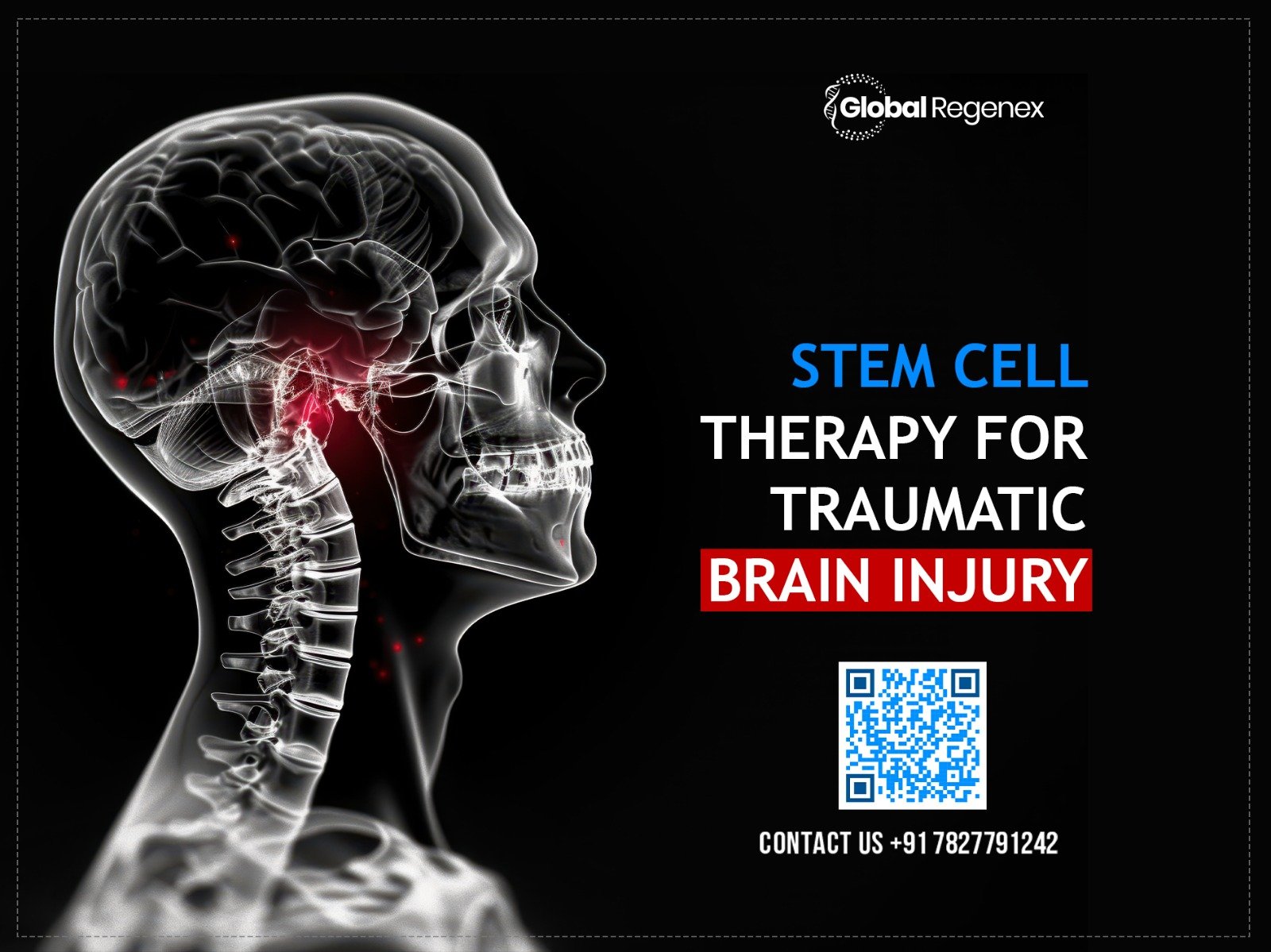 Stem Cell Therapy for Traumatic Brain Injury
