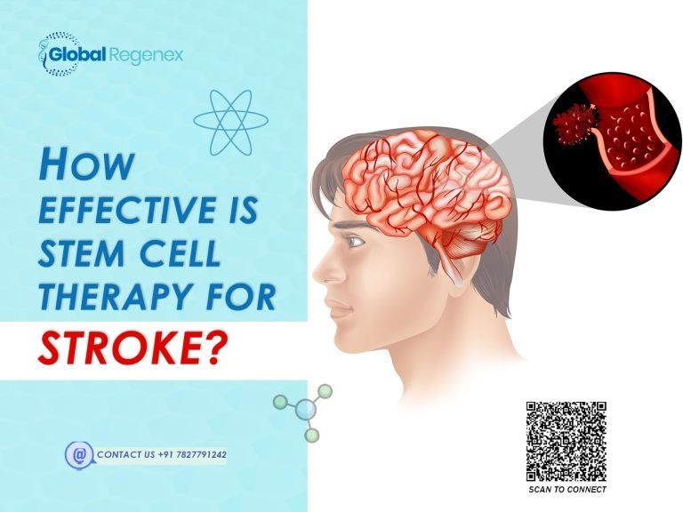 How Effective Is Stem Cell Therapy for Stroke?